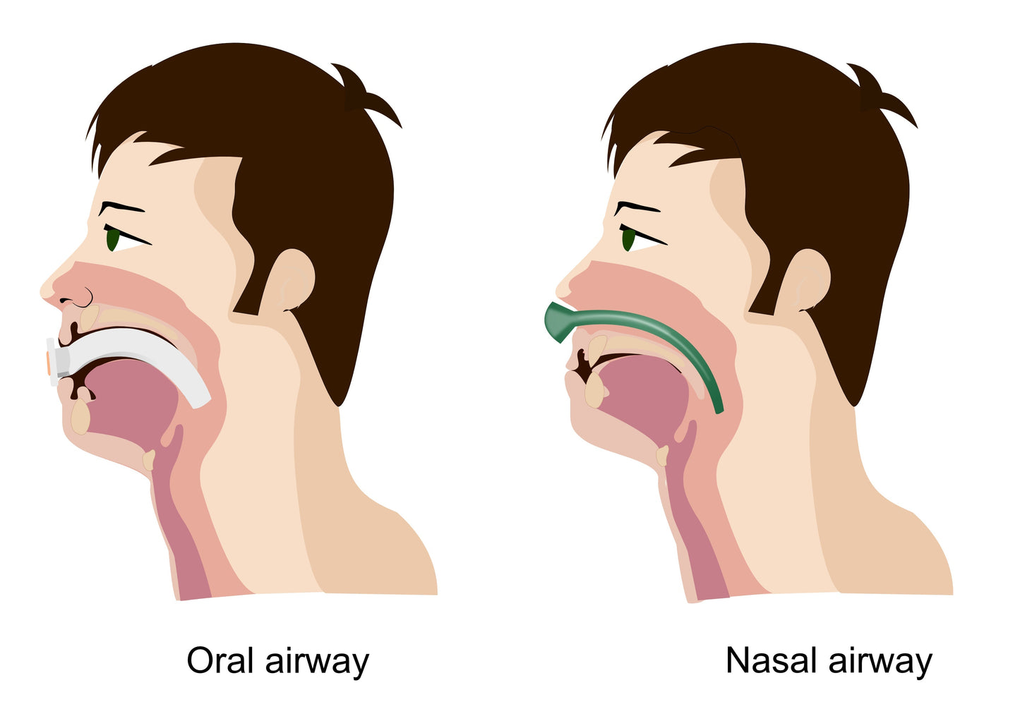 Complete Airway Emergency KIT #4